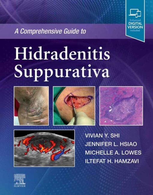 A Comprehensive Guide To Hidradenitis Suppurativa