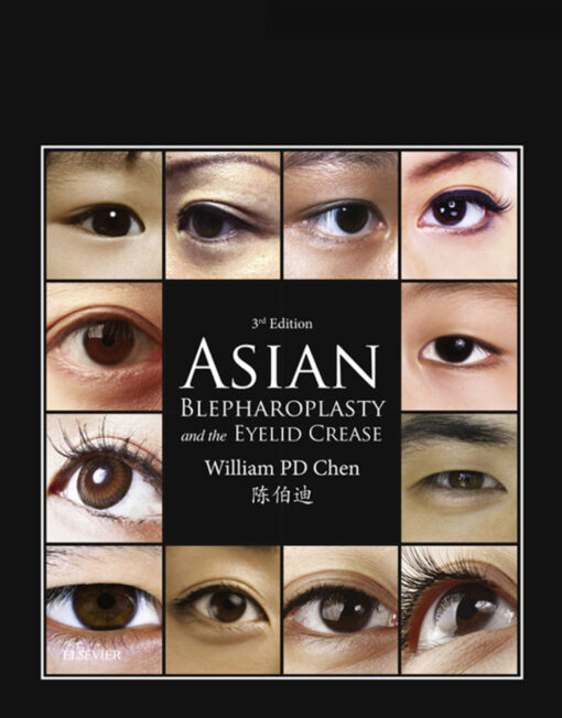 Asian Blepharoplasty And The Eyelid Crease 3rd Edition